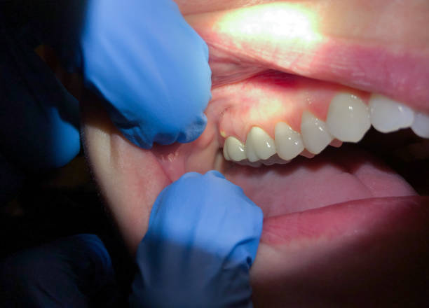 Best Dental Abscess Treatment in Forrest City, AR